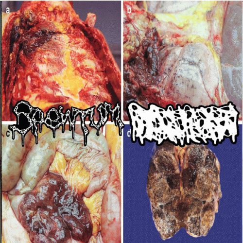 Spewtum : Spewtum - Hydrocephalus